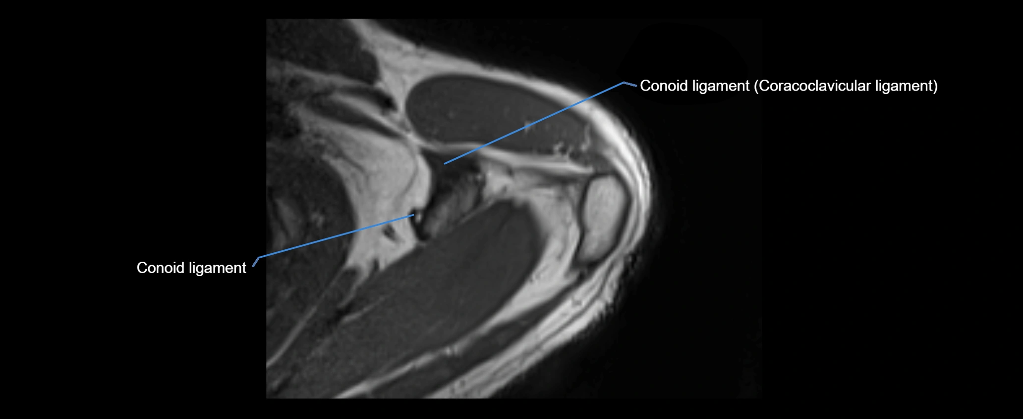 shoulder ligaments axial 3d 3t mri image-img-00005-00030.webp